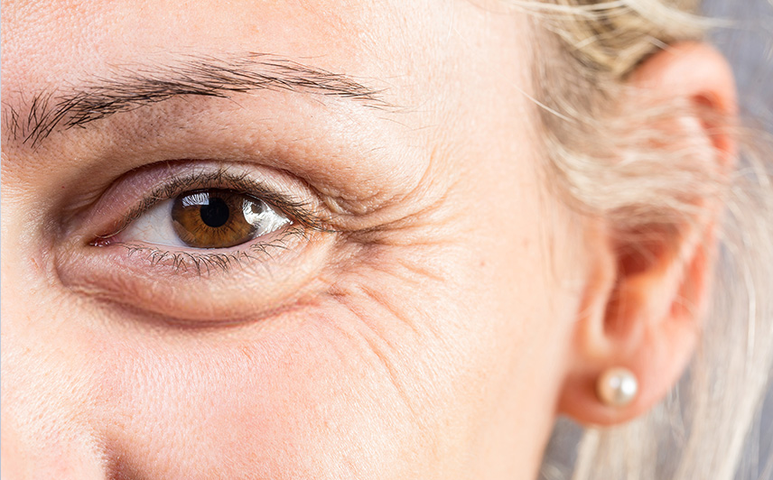 Морщины вокруг глаз: почему они появляются, как убрать в косметологии и в домашних условиях