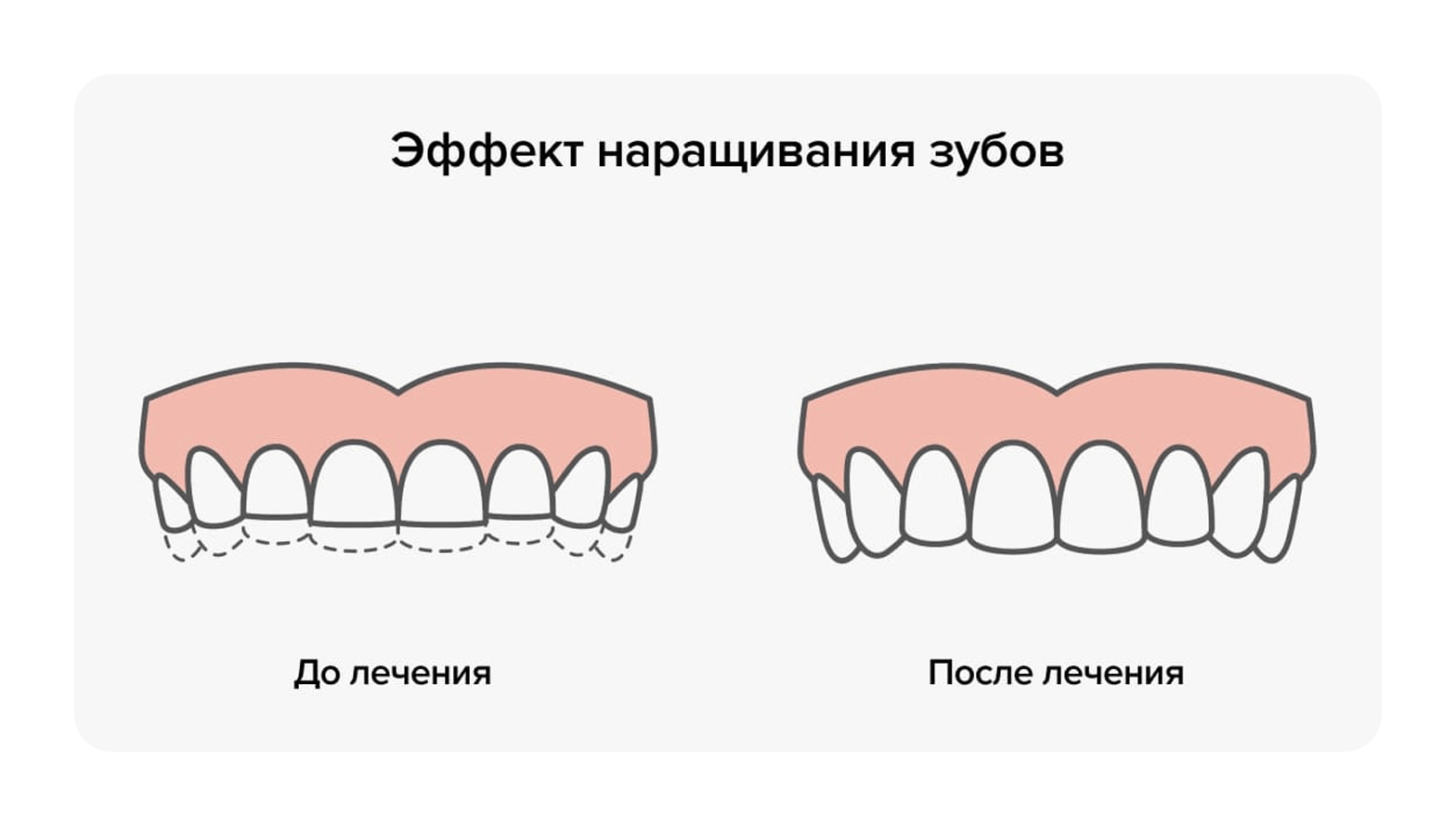 Бруксизм скрежетание зубами. Сильно сжатые зубы